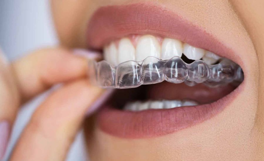 Variations in Invisalign Pricing and Its Effects on Stock Performance